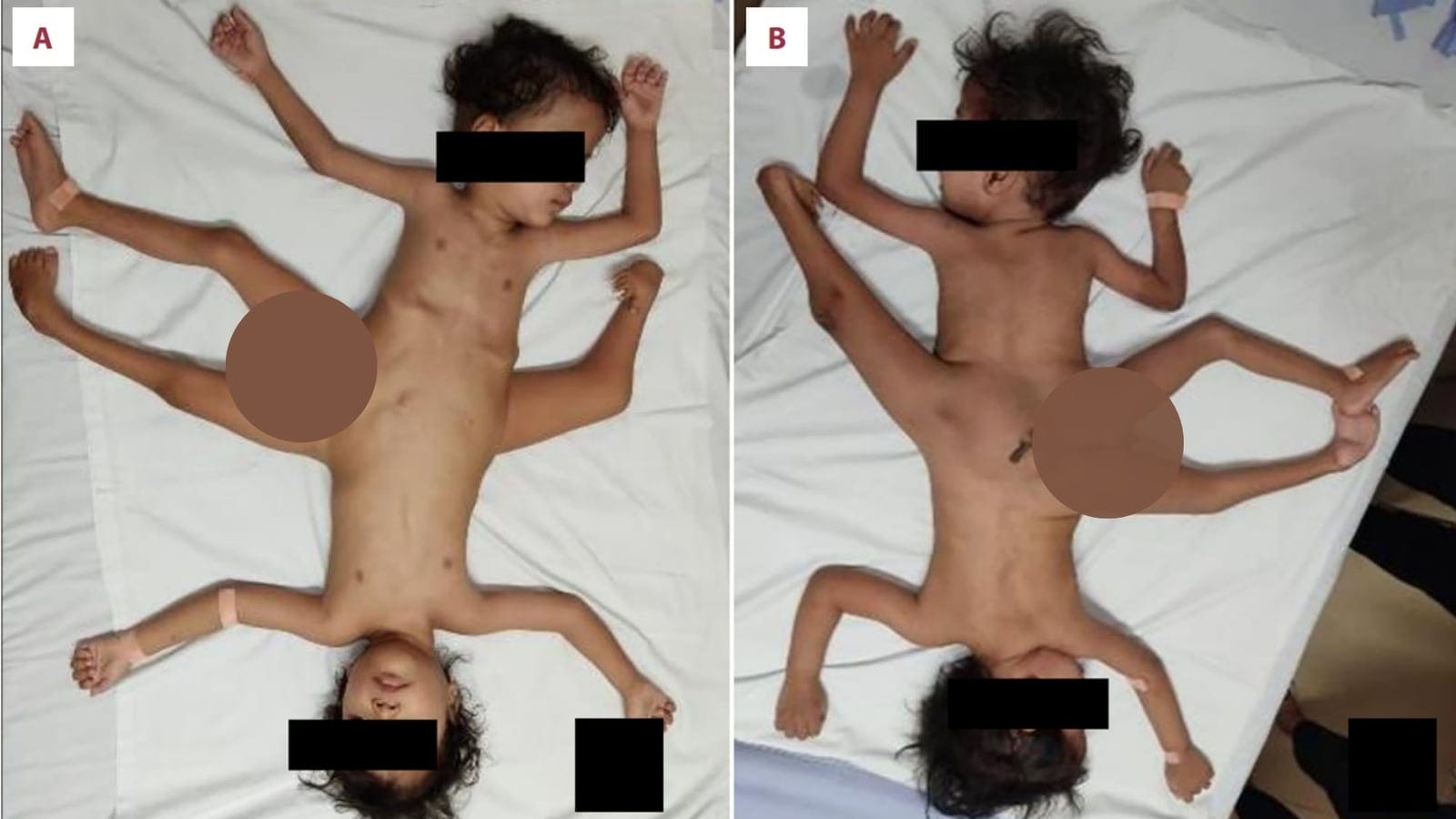 Extremely rare conjoined twins with 4 arms and 3 legs undergo corrective surgery